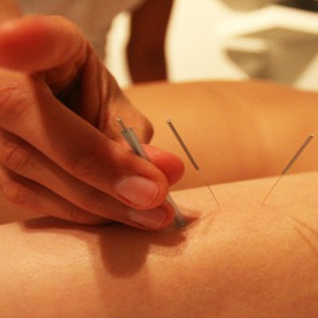 Acupuncture In Paris