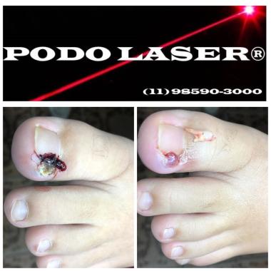 PODO LASER PODOLOGIA TABOÃO DA SERRA SÃO PAULO